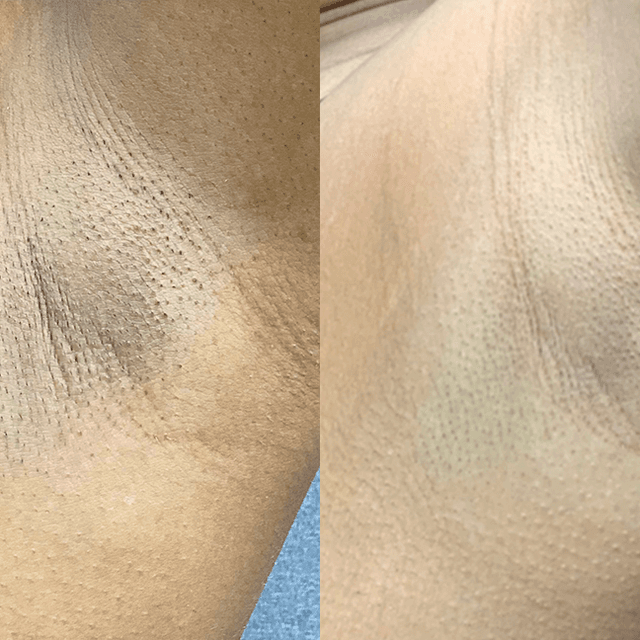 Laser Smooth at Jaylee’s Beauty Lounge in Eastchester, NY
